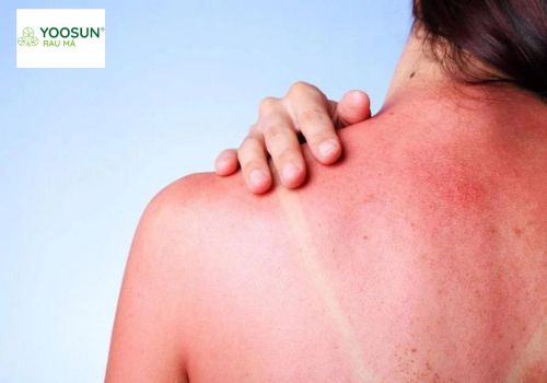 Da bị cháy nắng đỏ rát phải làm sao để da nhanh phục hồi?