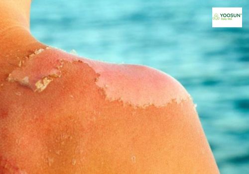 Cách xử lý da bị cháy nắng lột da, bong tróc hiệu quả nhất