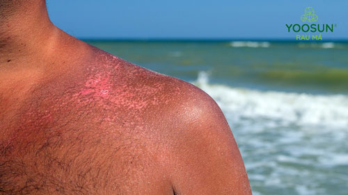 14 cách chữa và làm trắng da bị cháy nắng lâu ngày, lâu năm hiệu quả nhanh chóng