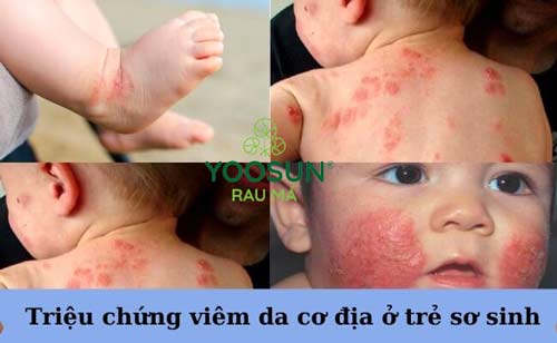 em bé bị viêm da cơ địa phải làm sao 