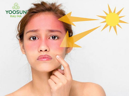 6 Cách phục hồi da mặt bị cháy nắng đơn giản tại nhà