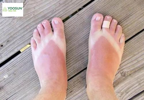 Biểu hiện và cách làm trắng da bàn chân bị cháy nắng nhanh