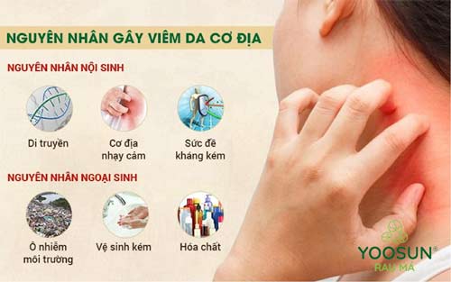 viêm da cơ địa có di truyền