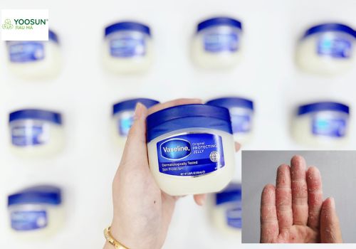 Bệnh viêm da cơ địa có nên bôi vaseline không