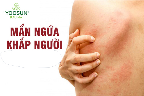 Nổi mẩn ngứa thành mảng khắp người: Nguyên nhân và giải pháp