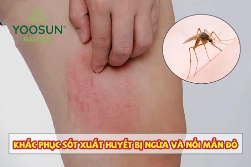 Mẩn ngứa do sốt xuất huyết phải làm sao? Cách xử lý