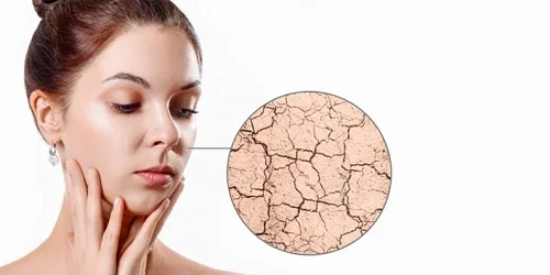 Da bị khô vào mùa hè 