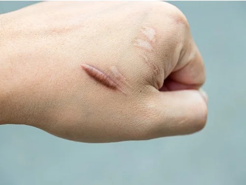 Bị bỏng có để lại sẹo không