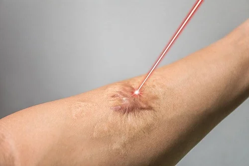 bị bỏng để lại sẹo không