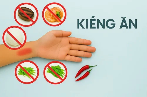 Bị bỏng kiêng ăn gì để không bị sẹo