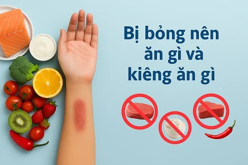 Bị bỏng kiêng ăn gì, nên ăn gì để tránh mưng mủ và nhanh lành?