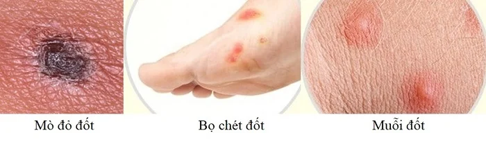 Bị mò đỏ cắn phải làm sao