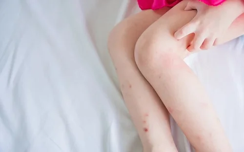 Bị rết cắn làm gì