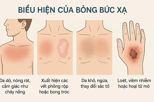 Biểu hiện của bỏng do bức xạ