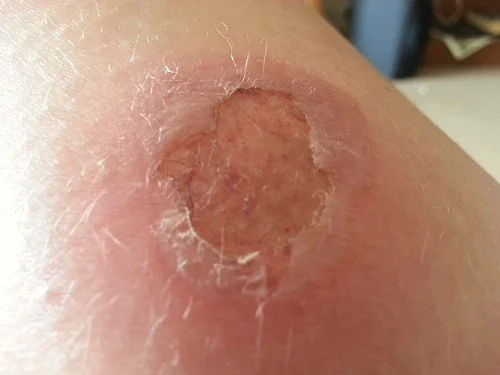 Bỏng cấp độ 2 là gì
