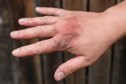 Bỏng do nhiệt