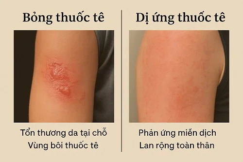 Bỏng do thuốc tê xăm hình