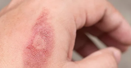 Các mức độ bỏng da