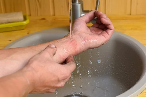 Cách chăm sóc vết bỏng độ 2