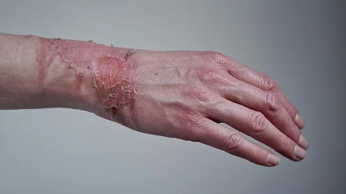 có mấy cấp độ bỏng da