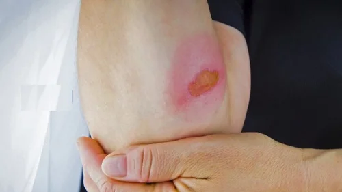 Bỏng cấp độ 2 là gì? Nguy hiểm không? Nhận biết và xử lý