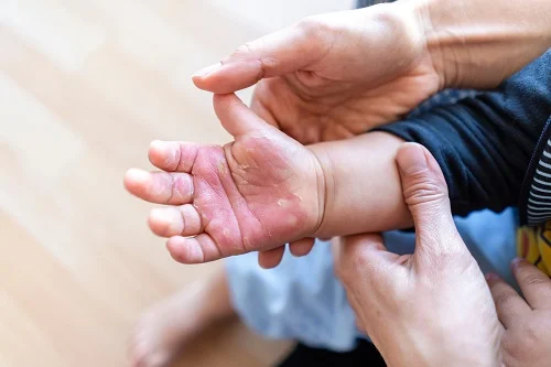 Hình ảnh bỏng cấp độ 1 