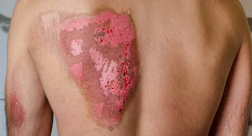 Hình ảnh các cấp độ bỏng da