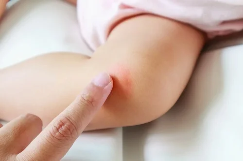 Trẻ bị muỗi đốt sưng cứng