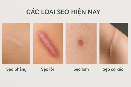 vết bỏng có để lại sẹo không