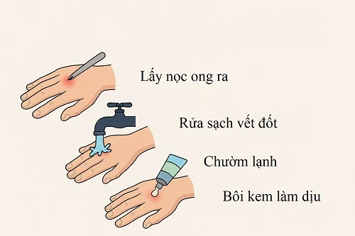 Xử lý khi bị ong đốt như thế nào