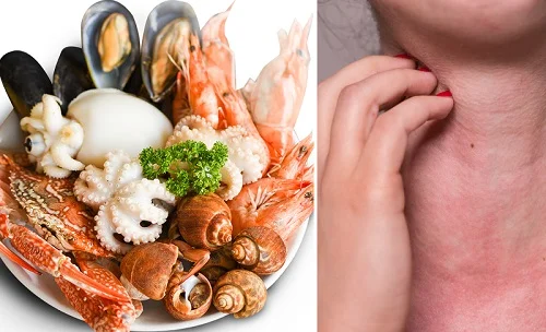 Bị dị ứng hải sản làm thế nào
