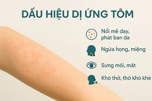 Bị dị ứng tôm có nguy hiểm không