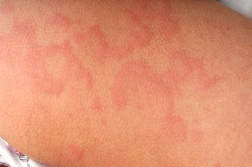 Dấu hiệu dị ứng thuốc kháng sinh