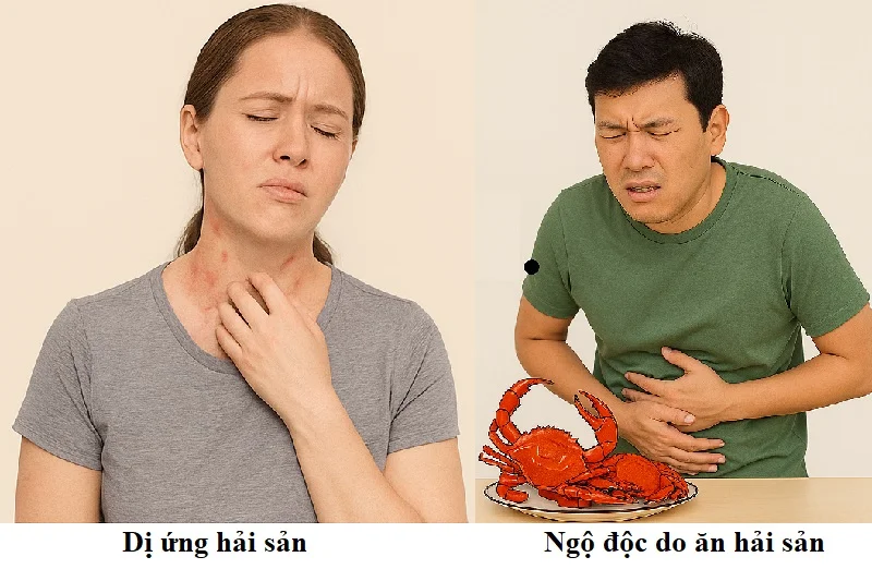 Dị ứng hải sản biểu hiện