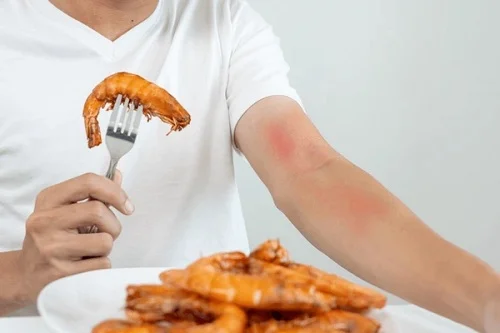 Dị ứng với tôm là như thế nào