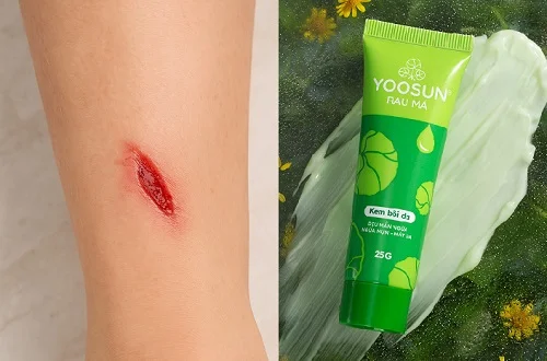 Yoosun Rau má bôi vết thương hở được không? Giải đáp
