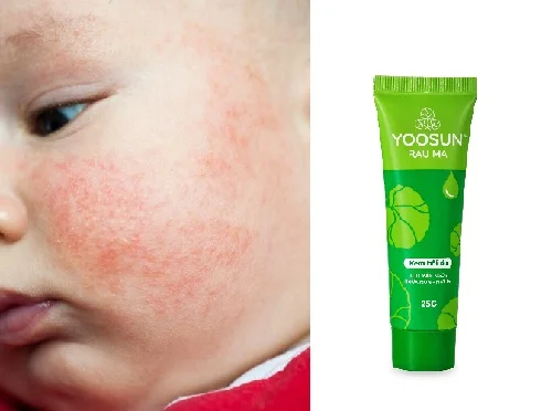 Kem Yoosun Rau Má có trị chàm sữa không?