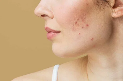 Kem bôi da yoosun rau má có trị mụn không