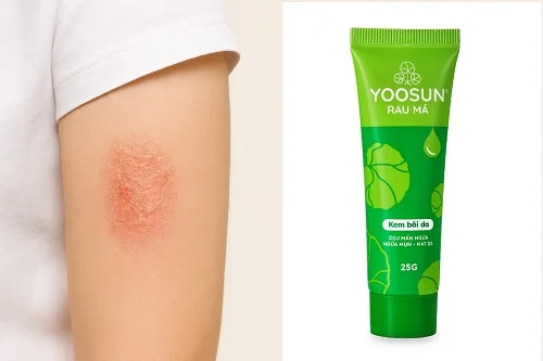 Yoosun Rau má có trị bỏng không? Có nên dùng?