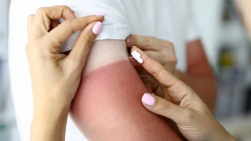 Kem rau má Yoosun trị bỏng được không