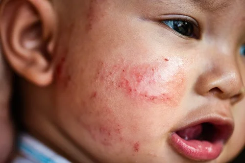 kem yoosun rau má có trị chàm sữa không