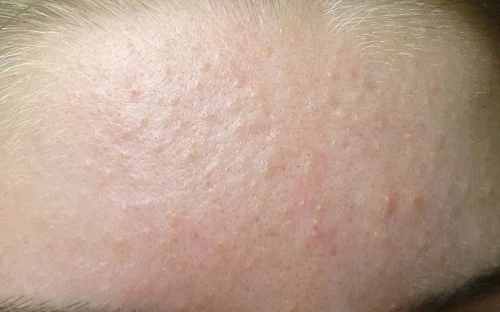 Kem yoosun rau má có trị mụn ẩn không