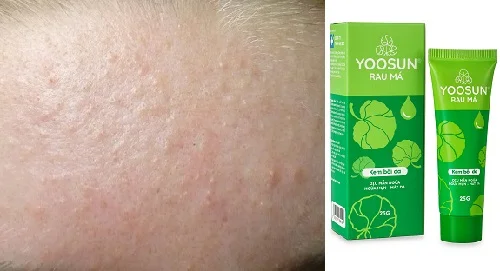 Yoosun Rau má có trị mụn ẩn không? Dược sĩ trả lời