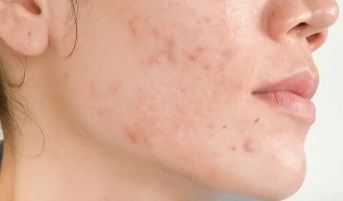 Yoosun Rau má có trị thâm không