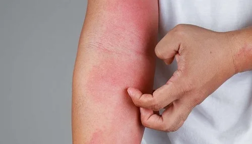 Bị dị ứng nước hoa là gì