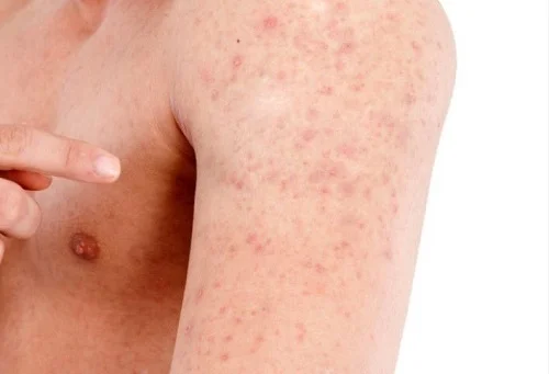 Bị dị ứng với thịt gà là như thế nào