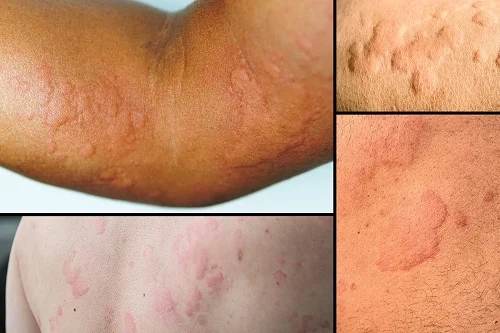 Biểu hiện ăn dứa bị dị ứng