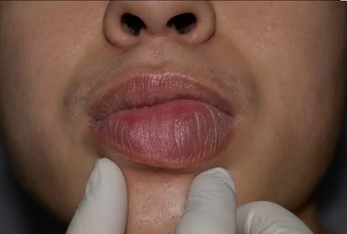 Biểu hiện dị ứng mì chính