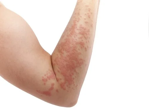 Biểu hiện dị ứng với nước hoa