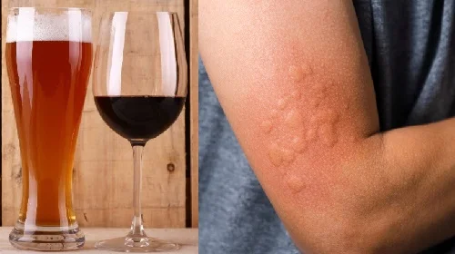 Dị ứng rượu bia: Mẹo nhận biết và xử trí thông minh